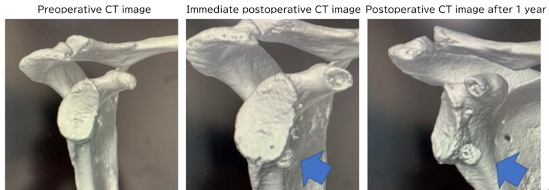 The CT images shows