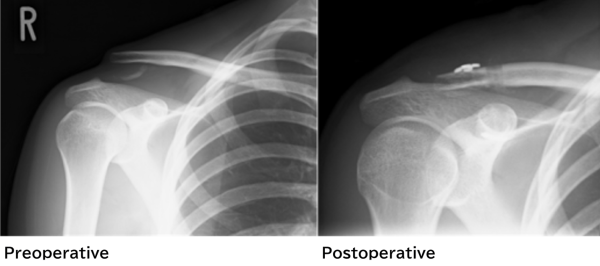 BeforeAfter operation