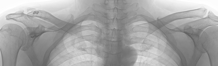 The X-ray below was taken two years after the surgery.