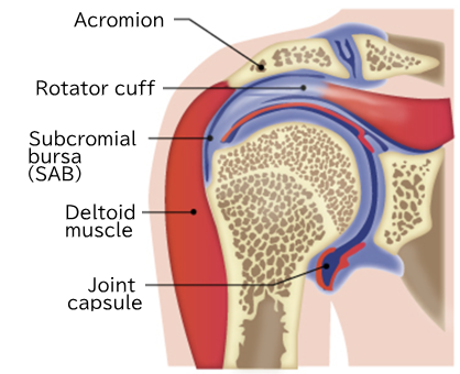 Adhesive capsulitis